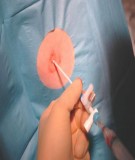 Giáo án khoa điều dưỡng - CHỌC HÚT DỊCH MÀNG BỤNG 