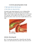 4 cách đơn giản phòng bệnh sỏi mật 